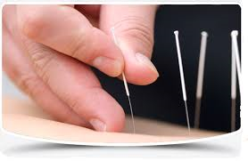 Dry Needling