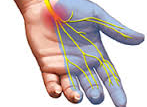 Carpal Tunnel Syndrome